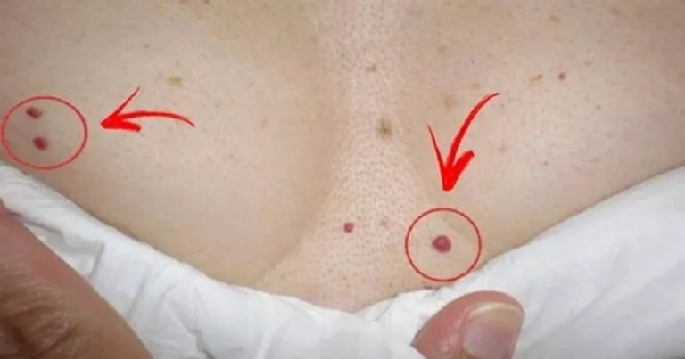 Fique alerta se surgirem bolinhas vermelhas em seu corpo; saiba o porque