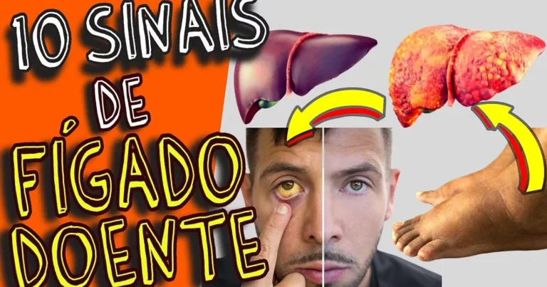 10 sinais de fígado doente que podem ser revelados através de seus pés e você não sabia