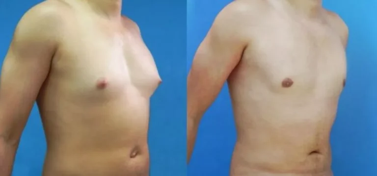 5 efeitos colaterais do álcool que ninguém te conta