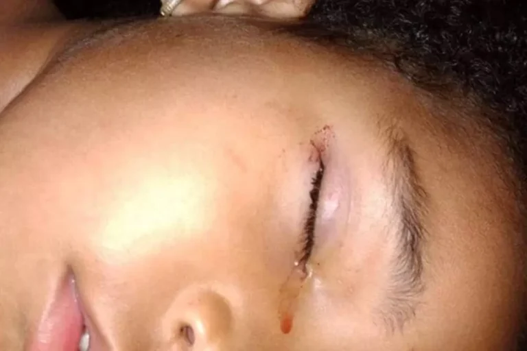 Criança de apenas 3 anos tem olho mordido por rato enquanto dormia no DF