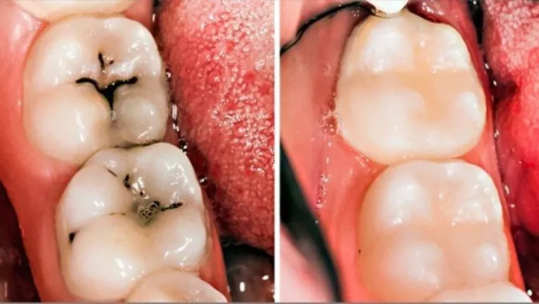 8 maneiras simples de reverter naturalmente as cáries e curar a deterioração dos dentes
