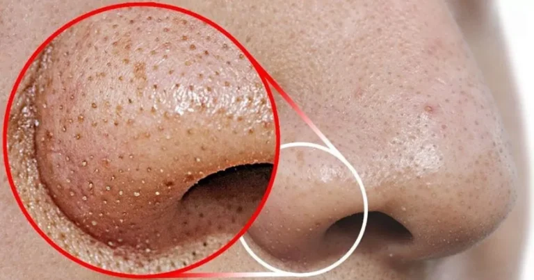 Você tem ou já teve cravos na pele? Então precisa saber disso urgentemente