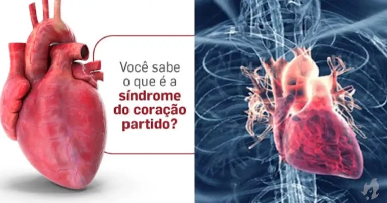 Síndrome do coração partido: causas e sintomas que jamais devem ser ignorados