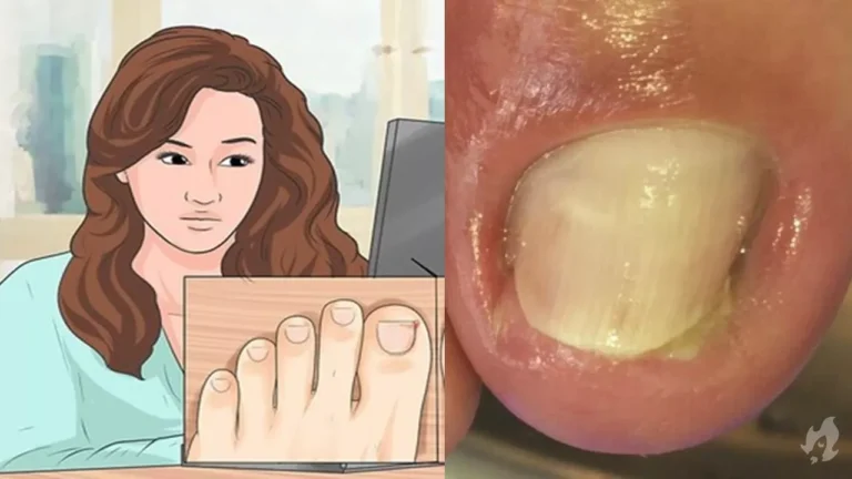 Tudo o que você precisa saber sobre unhas encravadas: tratamento eficaz e prevenção; vídeo