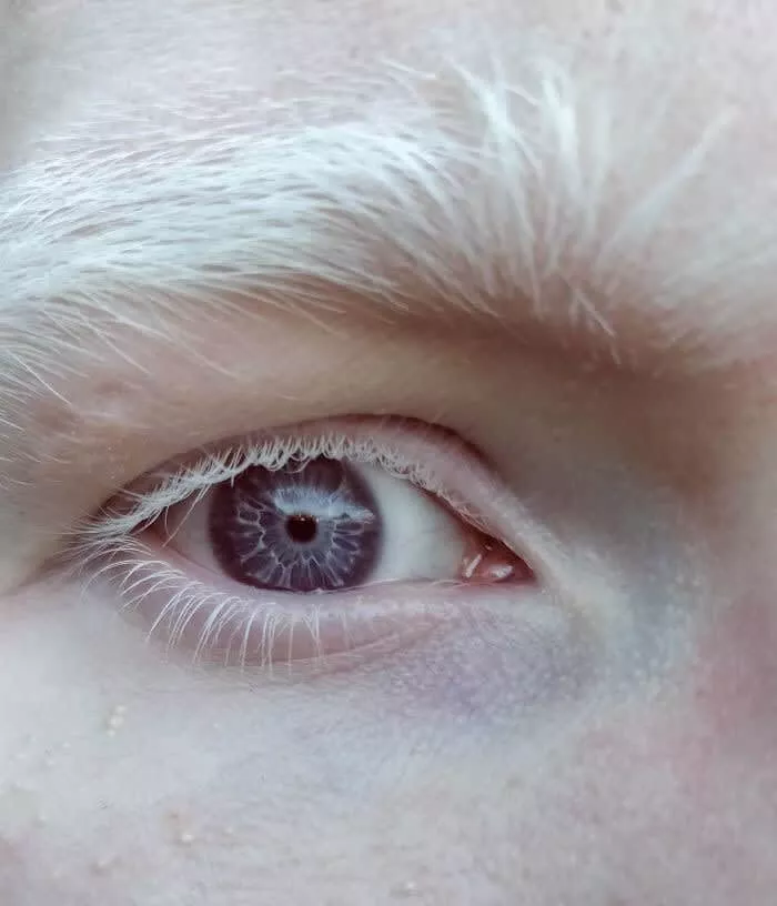 Albinismo Causando Olhos Relâmpagos