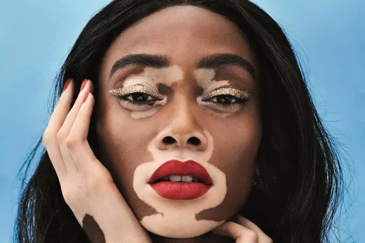 Modelo Mundial Famosa Com Vitiligo