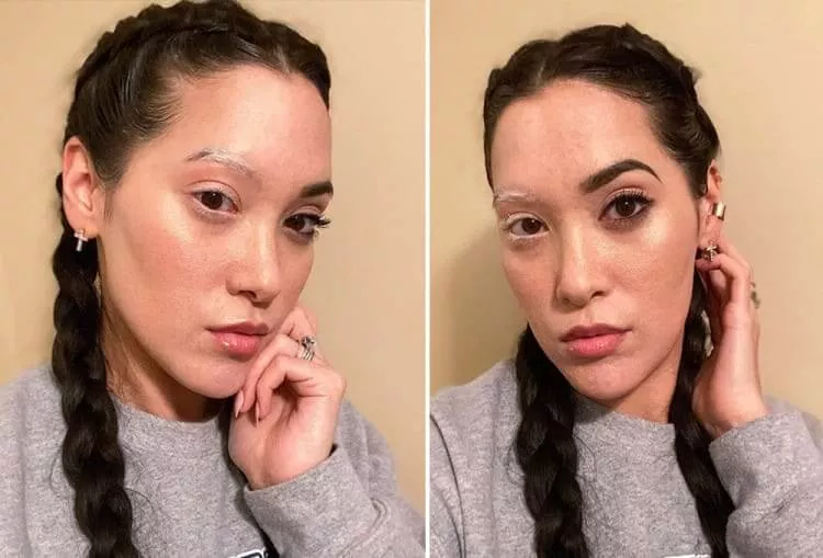 Vitiligo Muda Cor do Cabelo e Metade do Seu Rosto