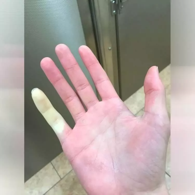 Dedo Fica Dormente no Inverno