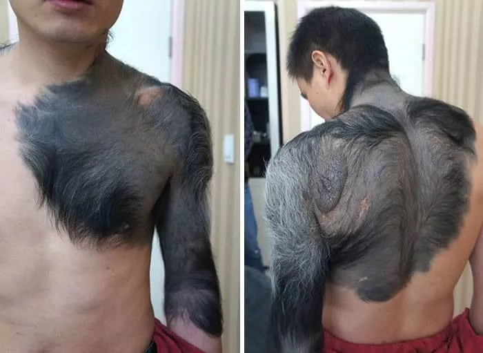 Verruga Gigante Peluda
