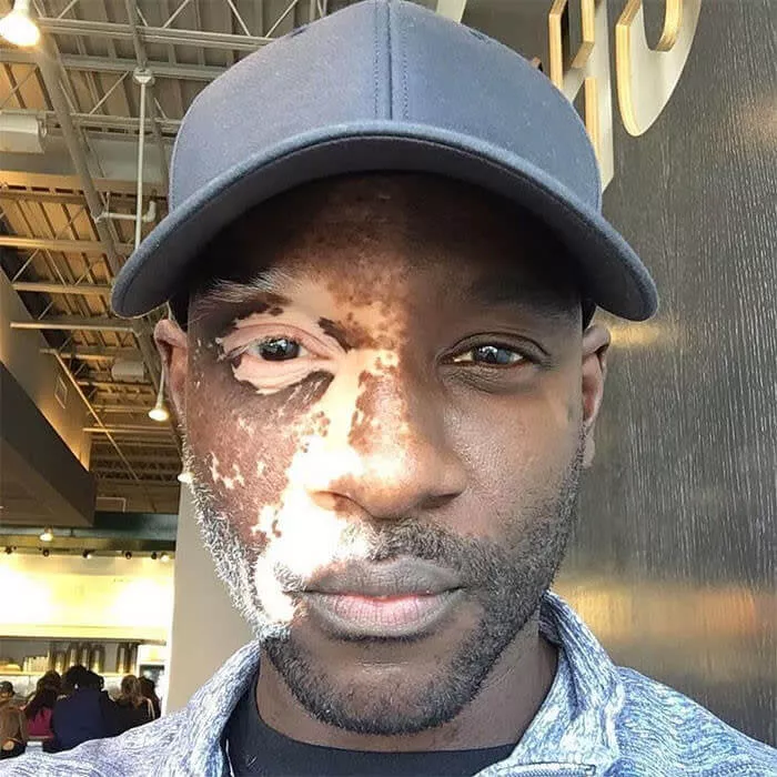 Vitiligo em Apenas Metade do Rosto