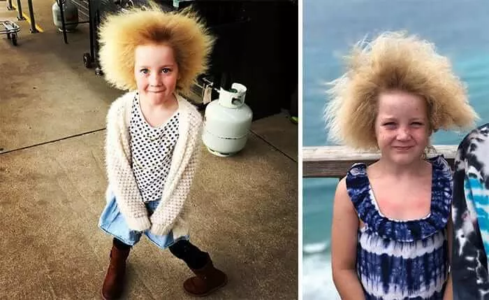 Síndrome do Cabelo Não Penteável