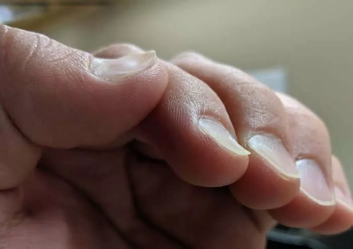 Unhas Invertidas