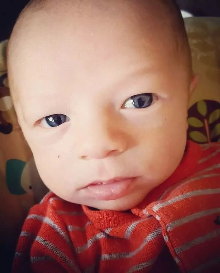 Coloboma em Ambos Olhos