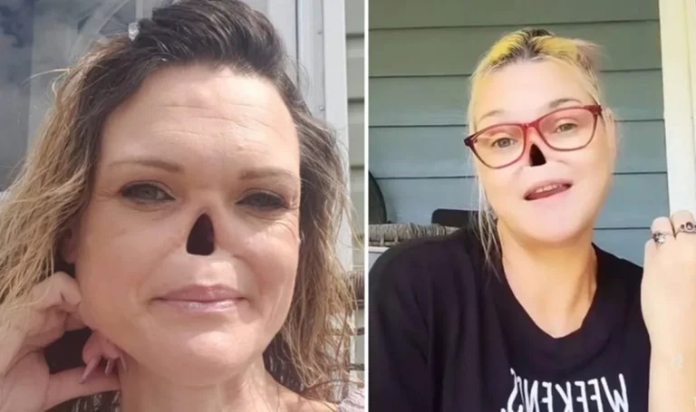 Mulher que teve o nariz retirado por conta de câncer expõe dificuldades: “Cuidar”
