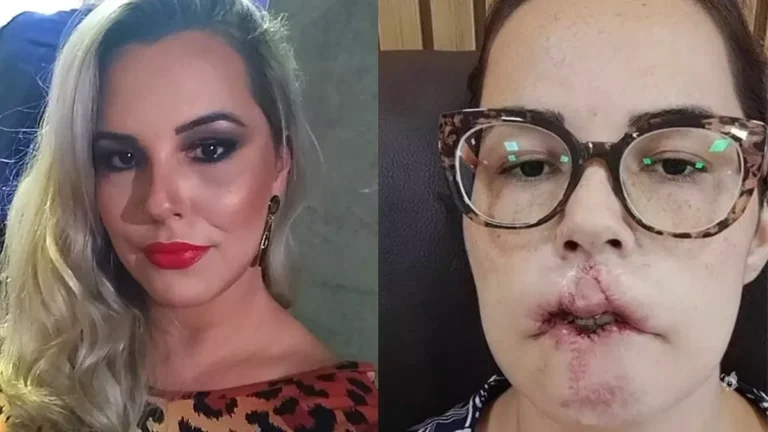 Influenciadora perde lábios após harmonização facial
