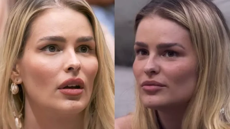 BBB 24: Yasmin Brunet precisa de atenção com lipedema, alerta especialista