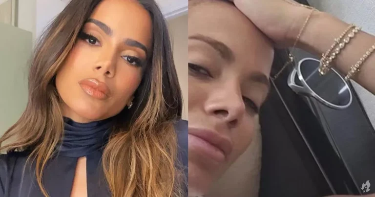 Anitta se preocupa com cicatriz após queimadura de água-viva “Muito medo”