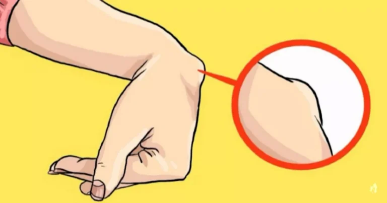 Você tem esse caroço no pulso? Pode ser sinal deste problema de saúde e existe tratamento