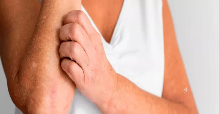 5 sinais na pele que indicam colesterol alto e precisam de atenção
