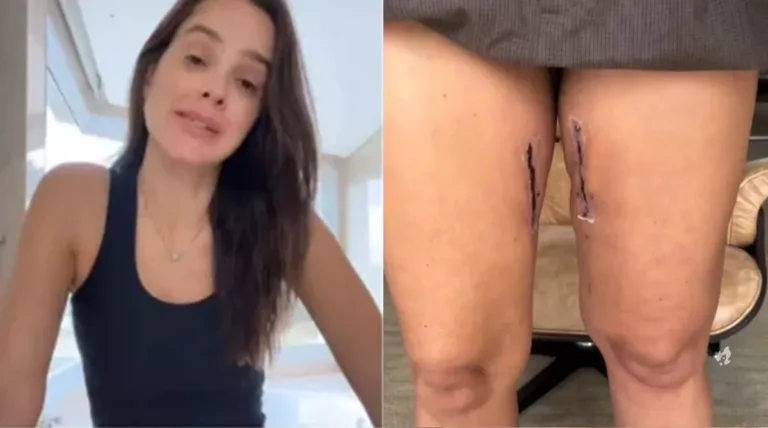 Vídeo: Vera Viel mostra cicatriz após cirurgia para retirada de tumor