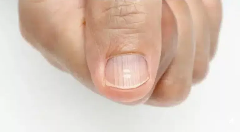 Sinal de alerta? Saiba agora o que são as listras que aparecem nas unhas