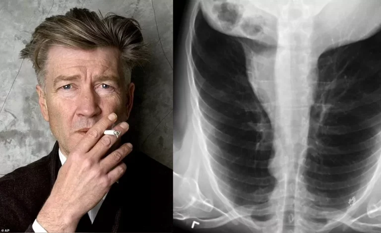 Enfisema pulmonar: entenda a doença que tirou a vida do diretor David Lynch