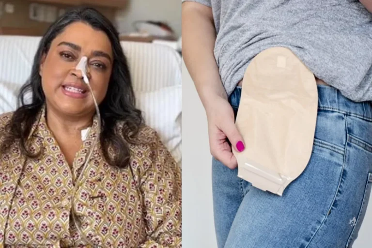 Caso Preta Gil: Bolsa de colostomia: o que é, para que serve e cuidados