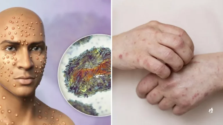 Sintomas da Mpox; como descobrir os primeiros sinais da condição