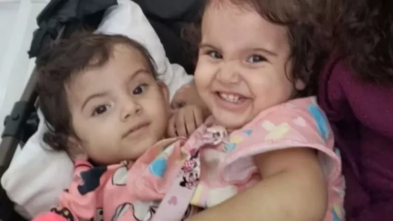 Qual a causa da morte da gêmea que não resistiu à cirurgia de separação que levou 19h?