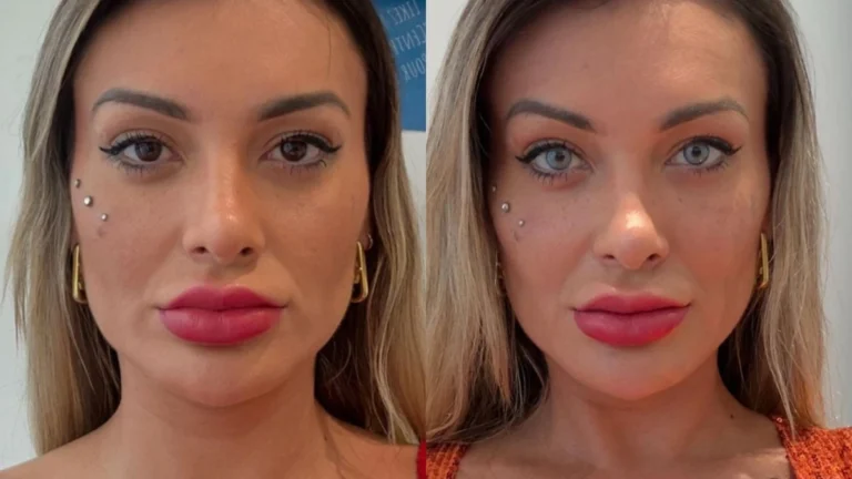 Andressa Urach reclama da mudança de cor de olho: “Não vale a pena a dor”
