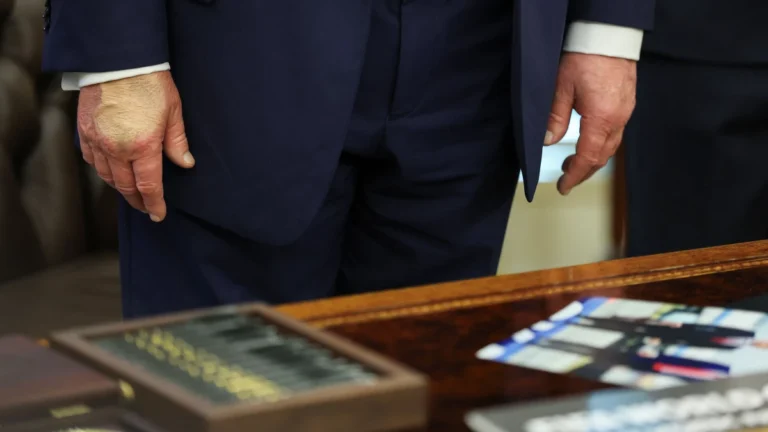 Trump reaparece com mão maquiada após diagnóstico de insuficiência venosa