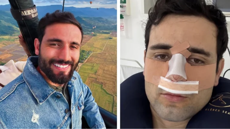Ex-BBB Matteus Amaral mostra resultado de cirurgia no nariz: “Estranho”