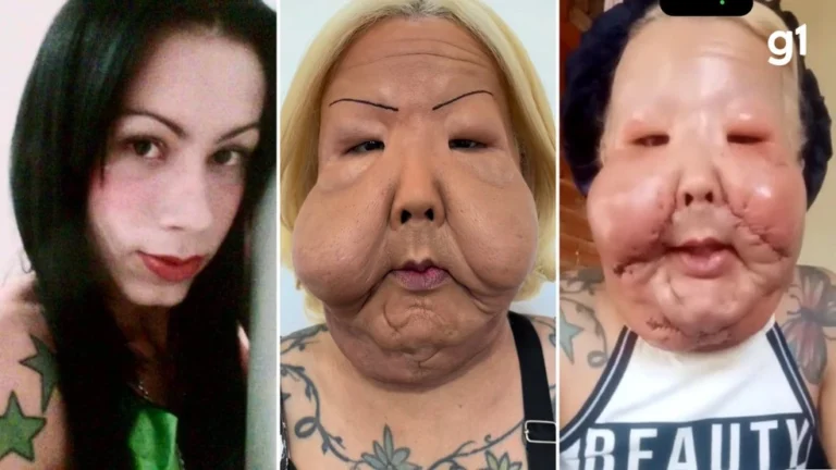 É fácil você rir, porque a dor não tá em você: Juju do Pix fala pela primeira vez após cirurgia reparadora