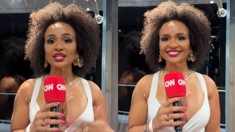 Ex-BBB Natália sobre vitiligo: “Ninguém tem o direito de me constranger”