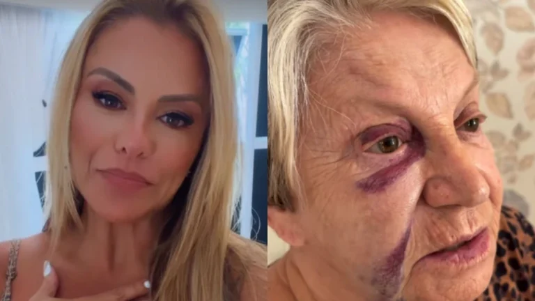 Mãe de Poliana Rocha, aos 84 anos, sofre acidente e fica com hematomas no rosto