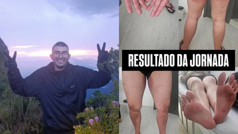 Irmã de jovem que se perdeu em trilha no Pico Paraná divulga imagens das lesões; veja