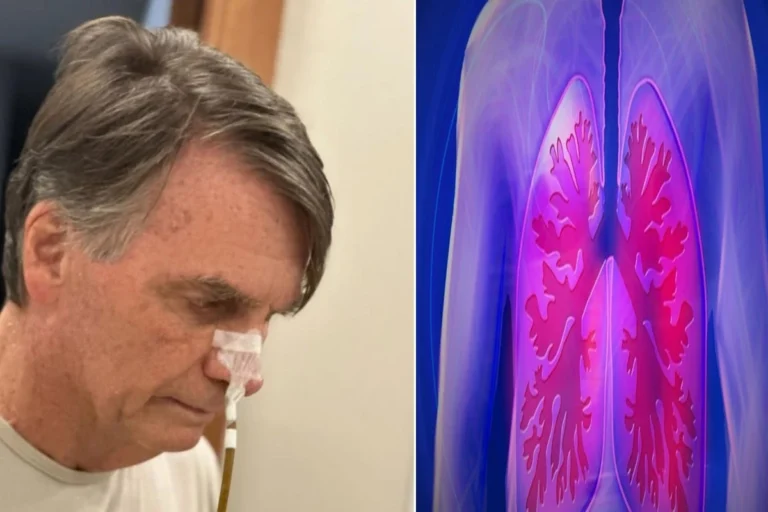 Saiba o que é e como evitar a broncoaspiração, doença que atingiu Jair Bolsonaro