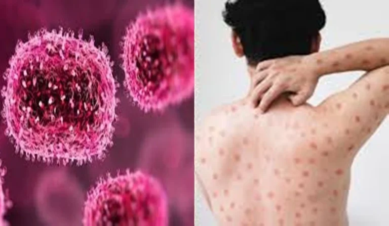 Urgente: Brasil registra 136 casos de Mpox em cinco novos estados