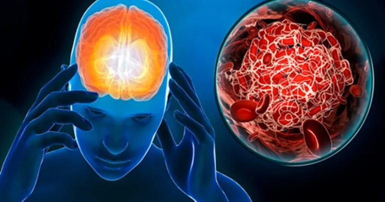 Neurologista explica sinais “silenciosos” do AVC que muita gente ignora
