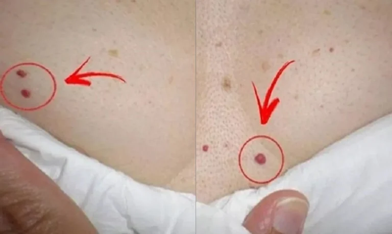 Fique alerta se surgirem bolinhas vermelhas em seu corpo; saiba o porque