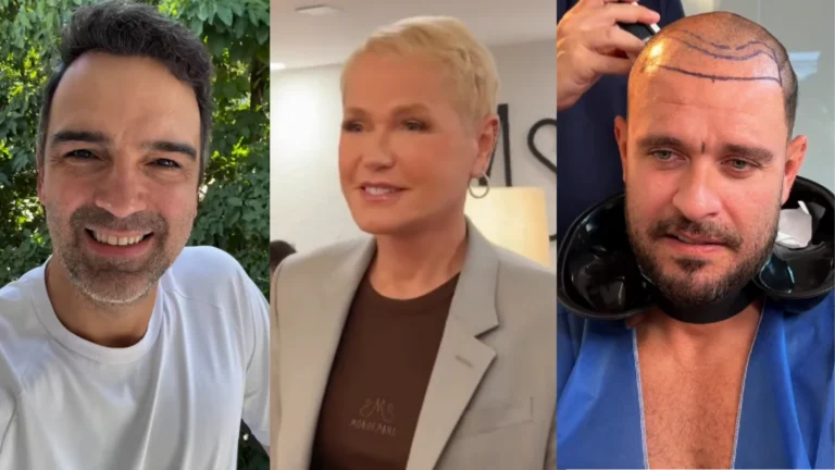 Como Xuxa Meneghel, veja famosos que fizeram transplante capilar