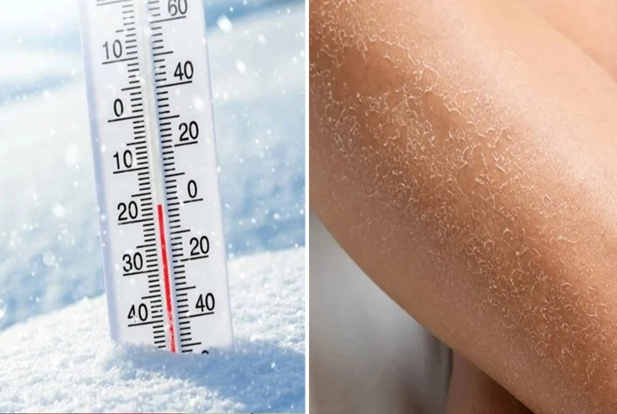 Pele irritada e descamando? Descubra 5 cuidados essenciais neste inverno