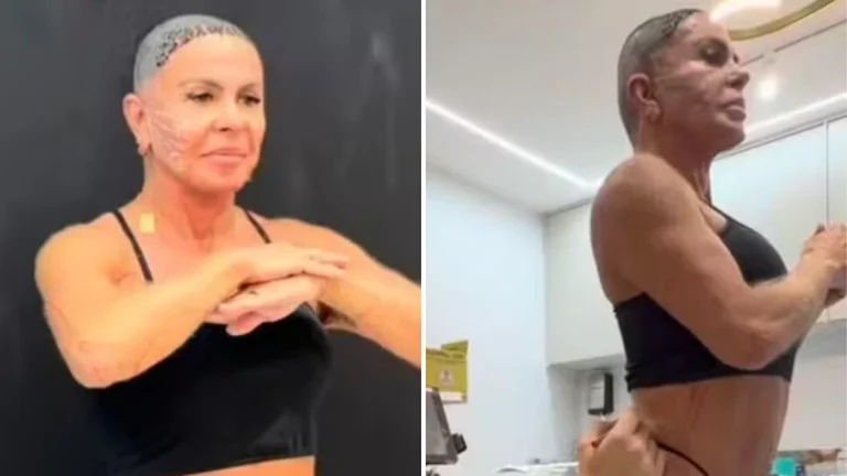 Gretchen faz procedimentos no rosto e no corpo após transplante capilar: ‘Resultado incrível’