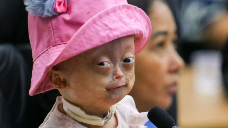 Morre Elis, influenciadora com síndrome da velhice precoce, aos 5 anos